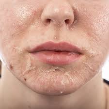 Chemical Peel Course